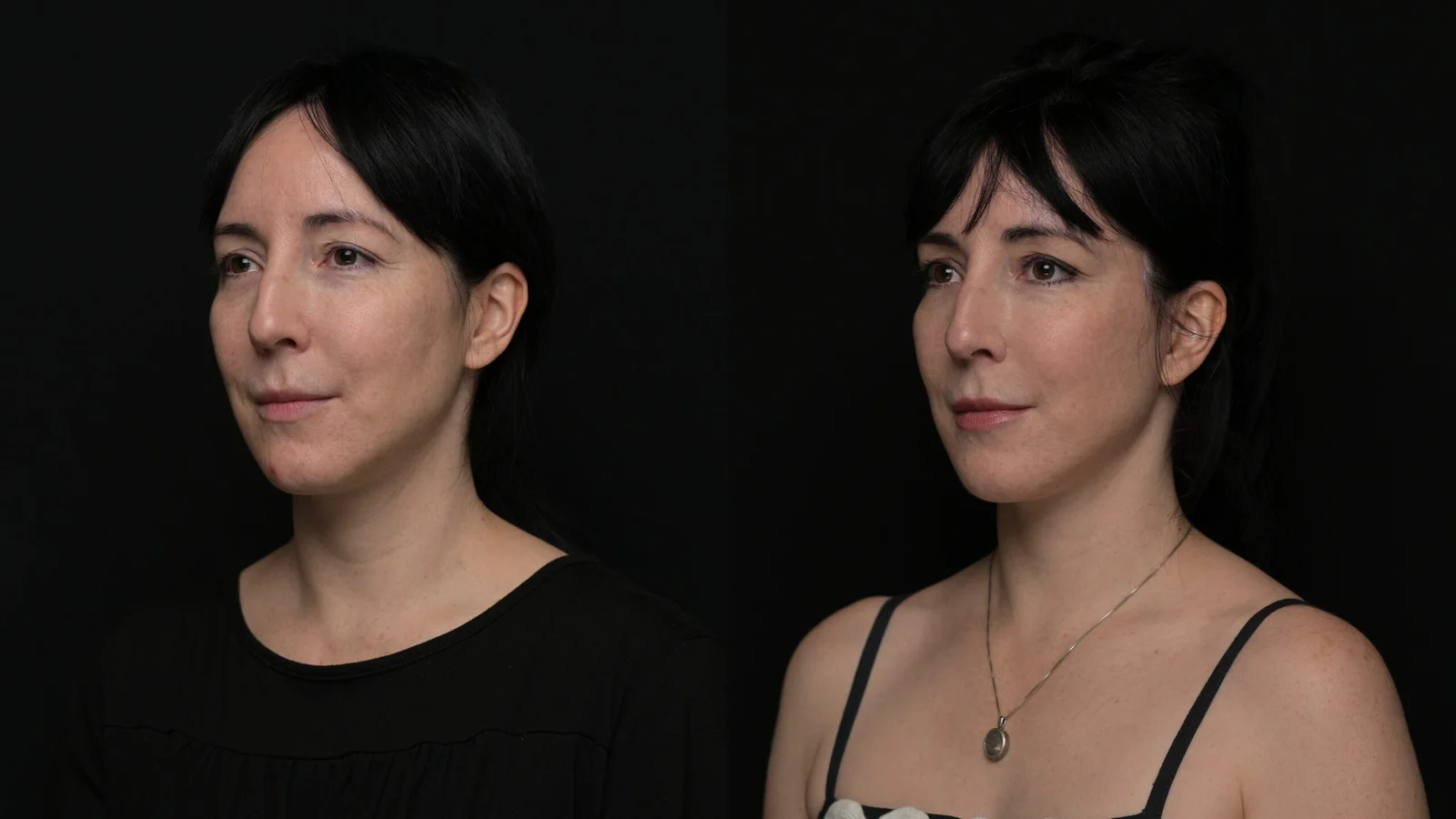 Before-and-after photograph, deep plane facelift and neck lift