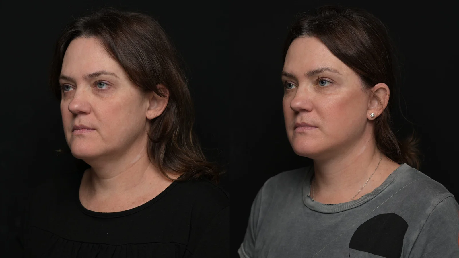 Before-and-after photograph, deep plane facelift and neck lift