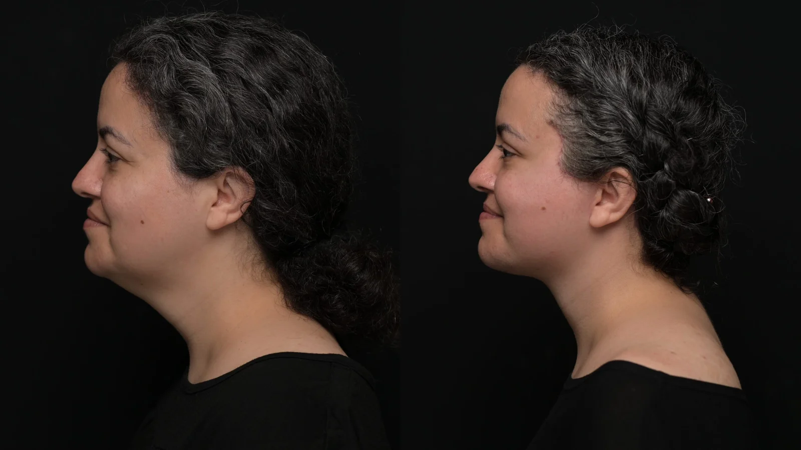 Before-and-after photograph, deep plane facelift and neck lift