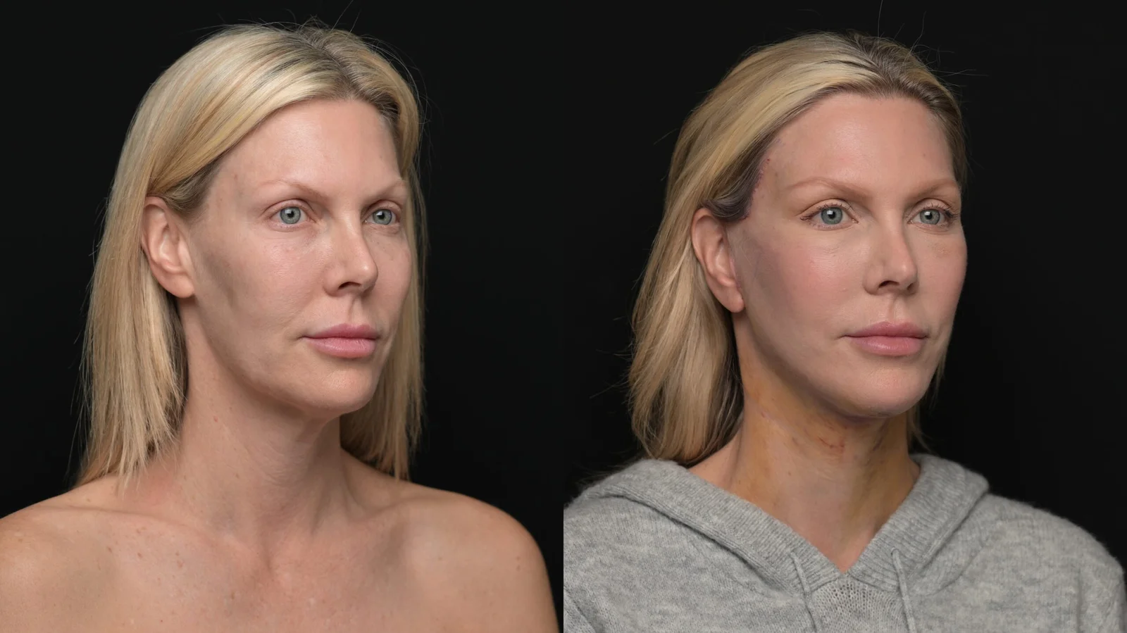 Before-and-after photograph, deep plane facelift and neck lift