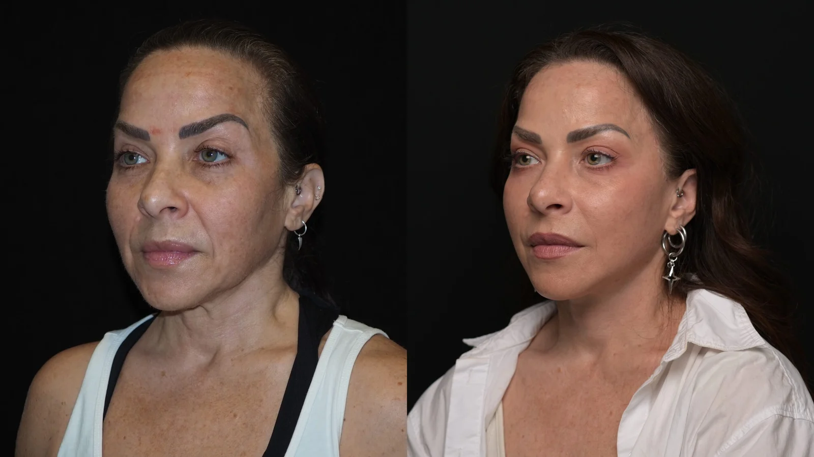 Before-and-after photograph, deep plane facelift and neck lift