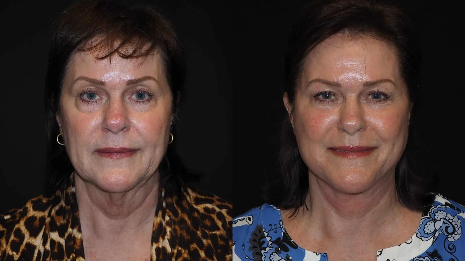 Before-and-after photograph, deep plane facelift and neck lift
