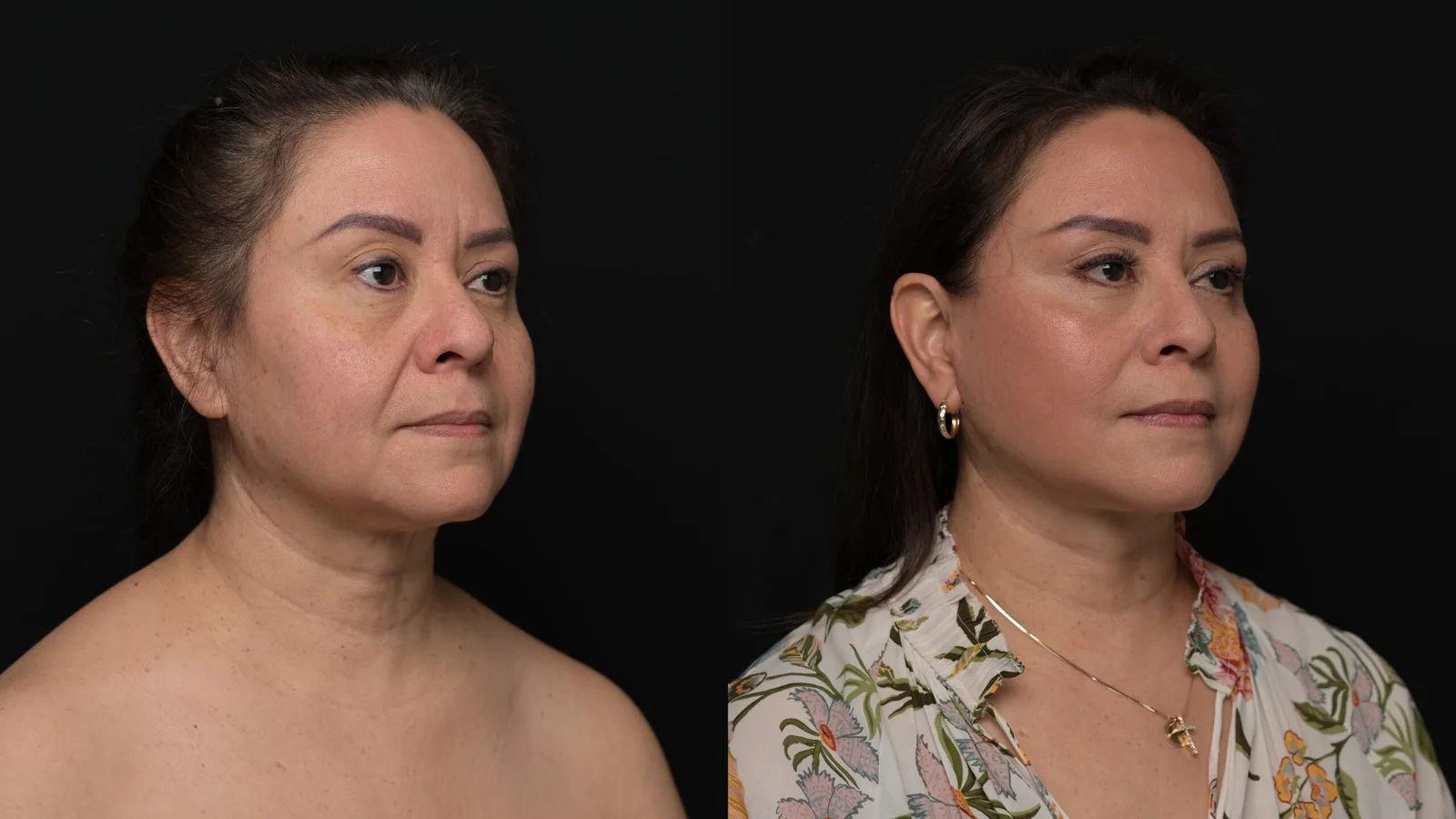 Before-and-after photograph, deep plane facelift and neck lift