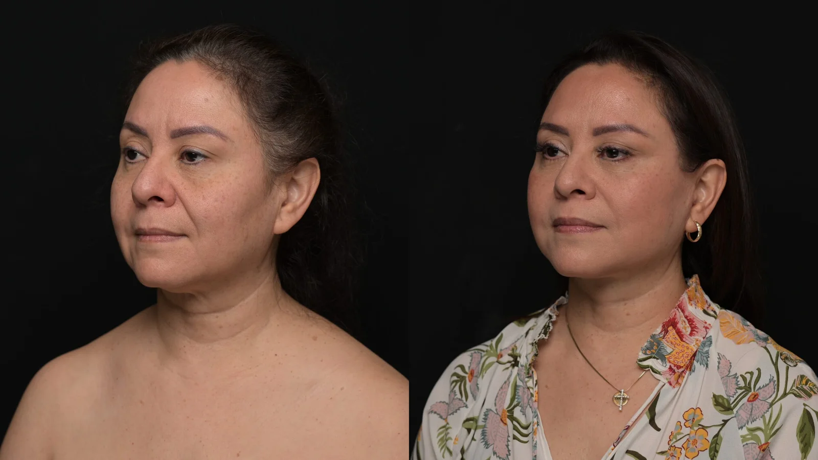 Before-and-after photograph, deep plane facelift and neck lift
