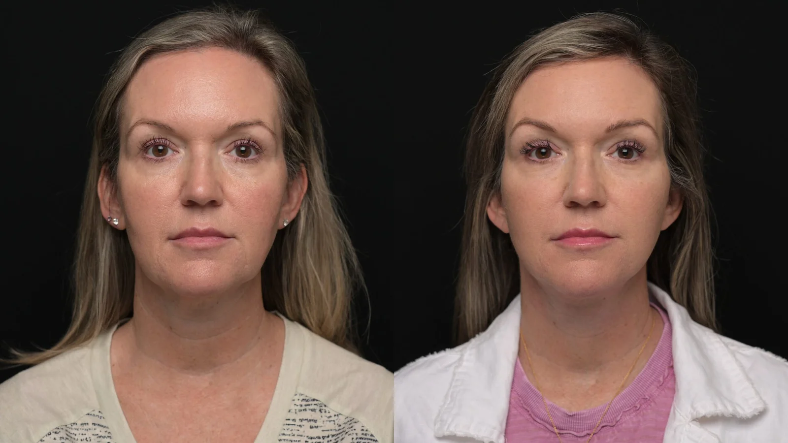 Before-and-after photograph, deep plane facelift and neck lift