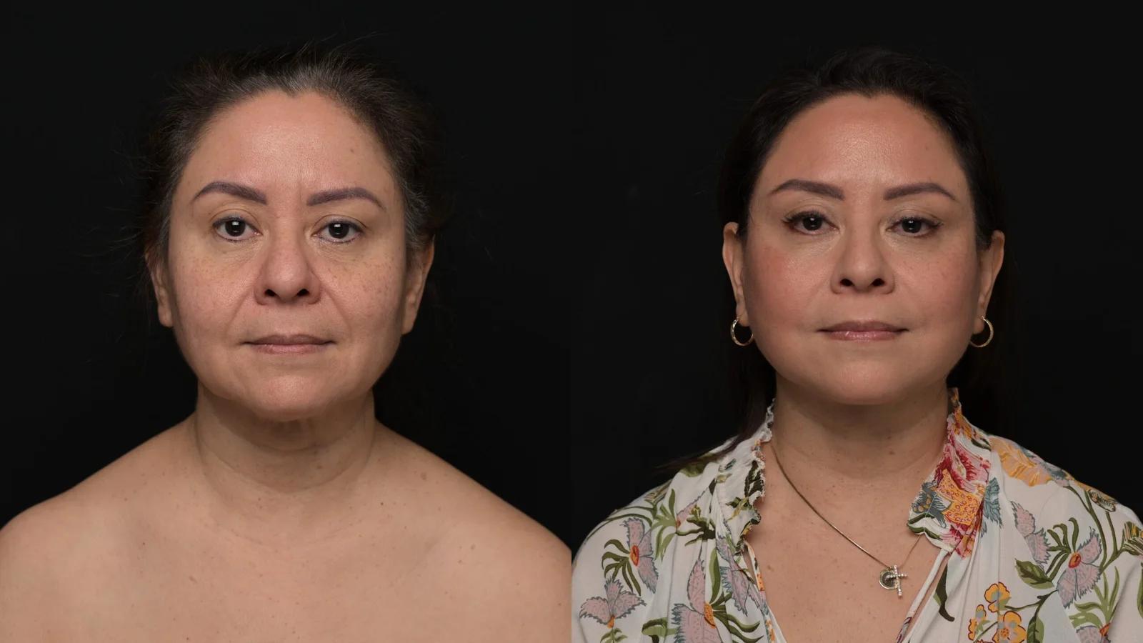 Before-and-after photograph, deep plane facelift and neck lift