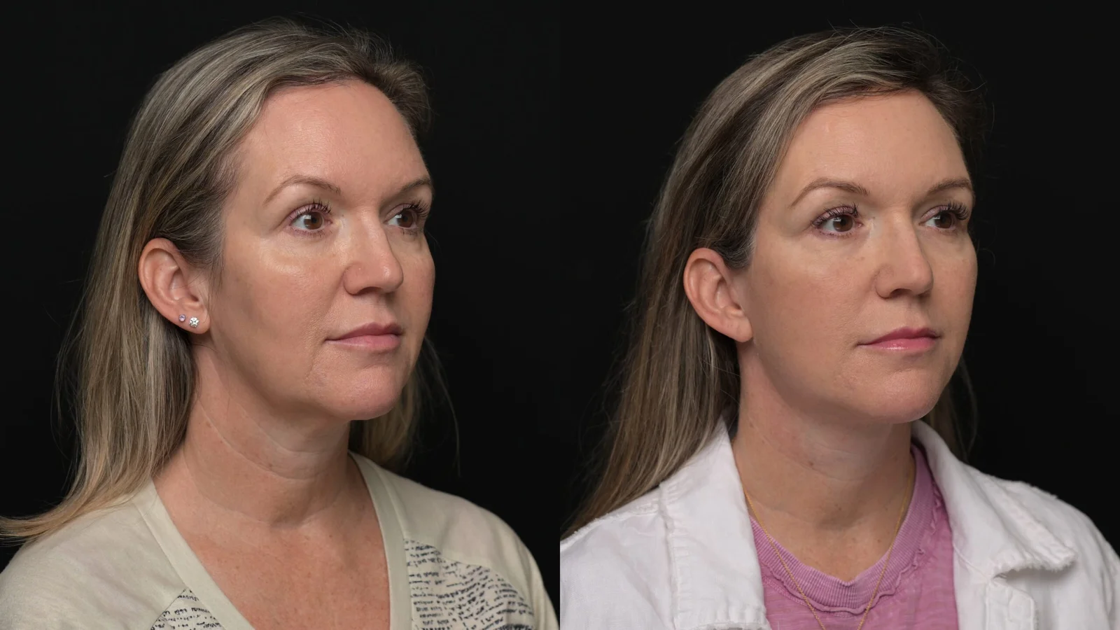 Before-and-after photograph, deep plane facelift and neck lift