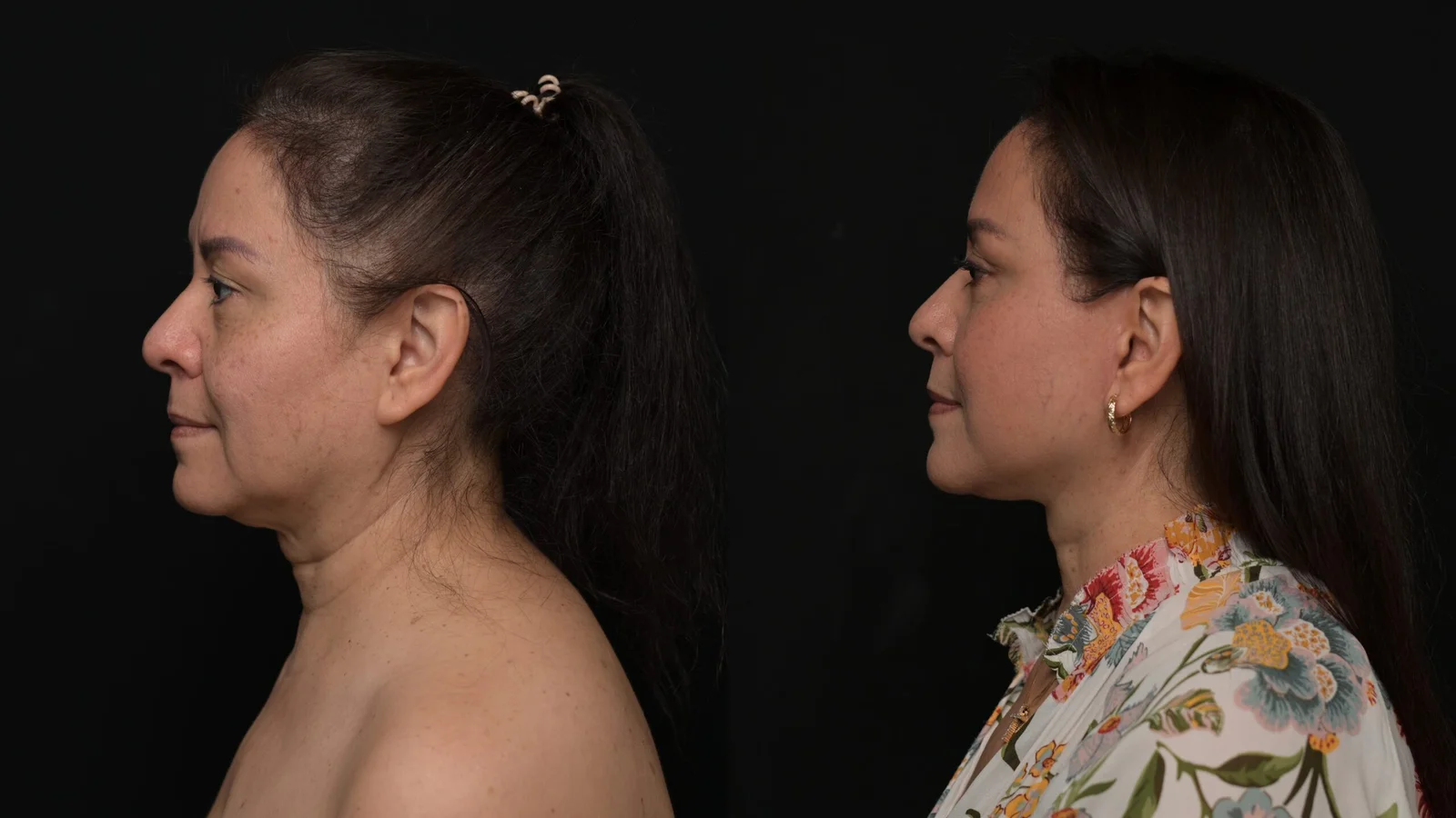 Before-and-after photograph, deep plane facelift and neck lift