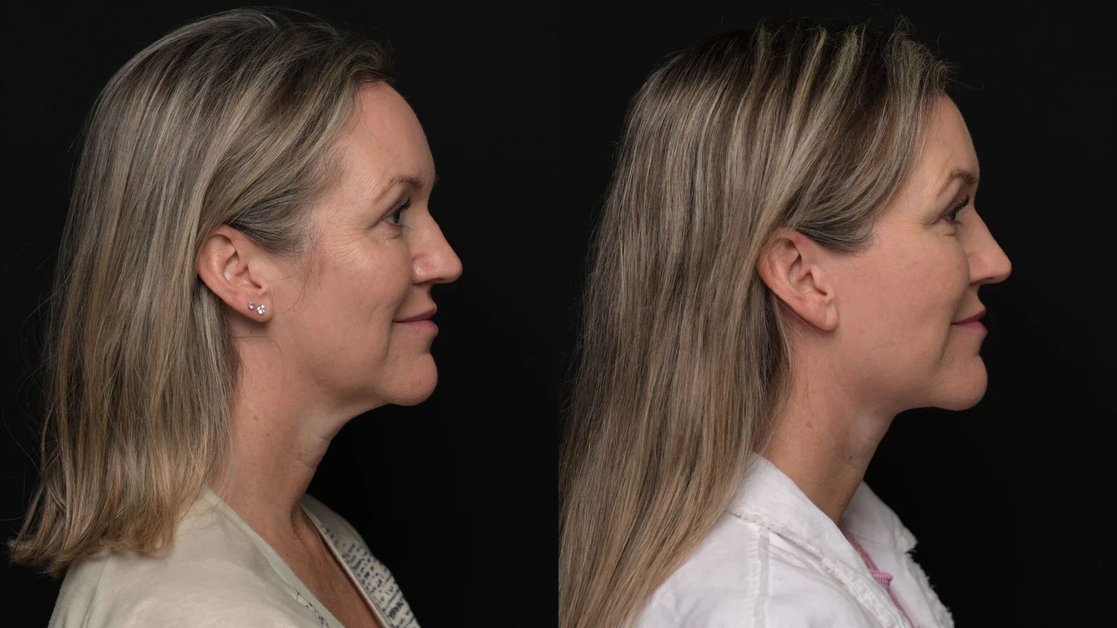 Before-and-after photograph, deep plane facelift and neck lift