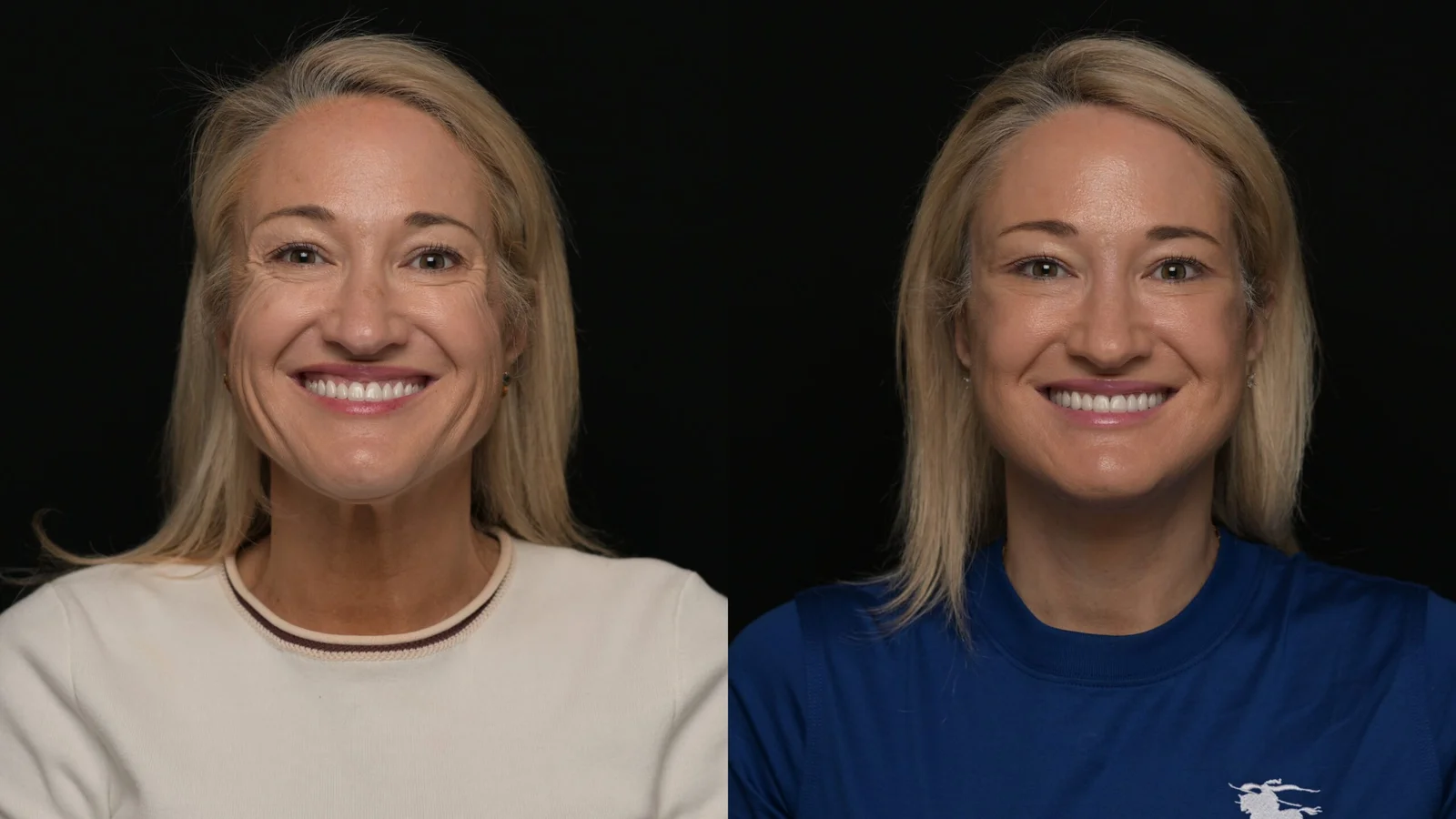 Before-and-after photograph, deep plane facelift and neck lift