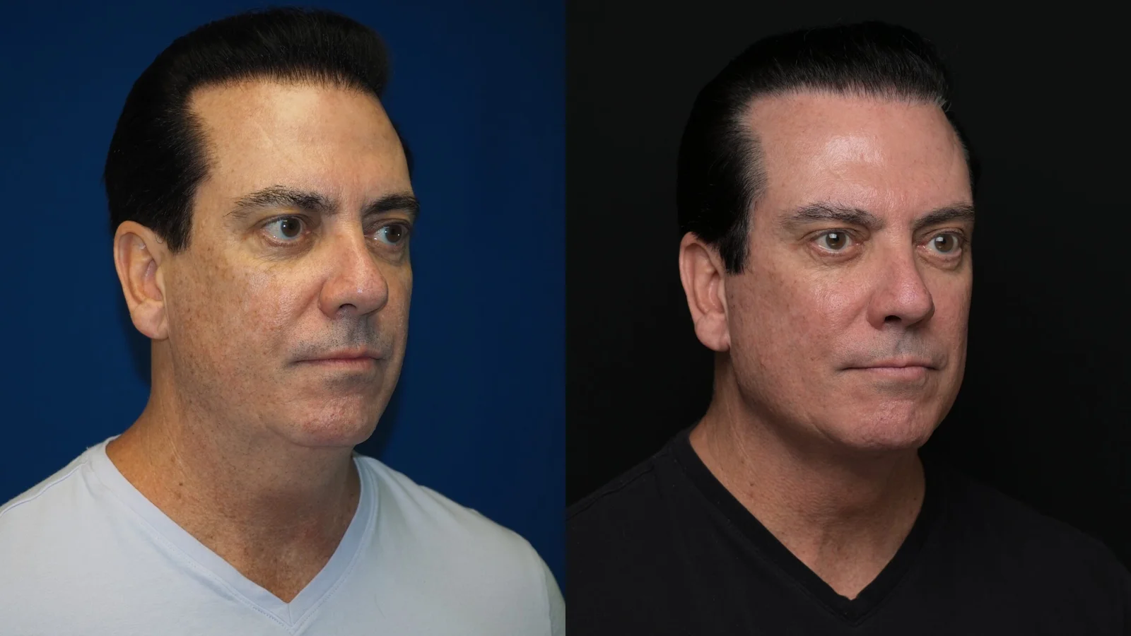 Before-and-after photograph, deep plane facelift and neck lift