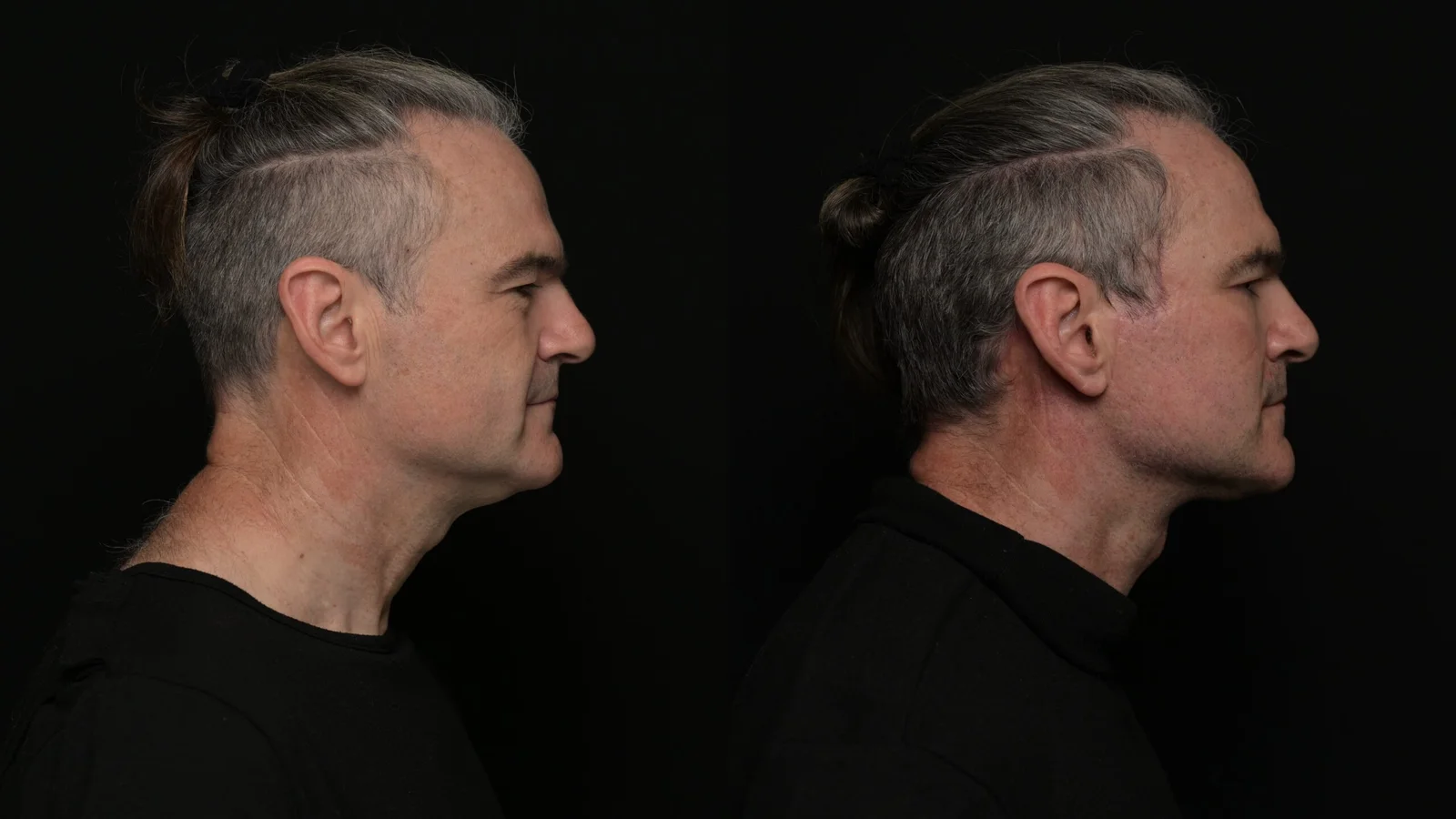 Before-and-after photograph, deep plane facelift and neck lift
