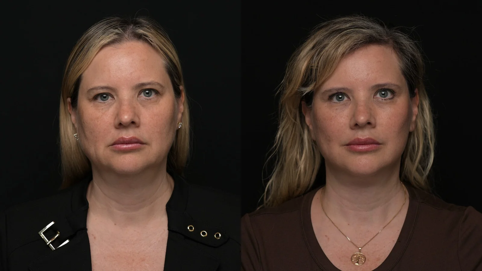 Before-and-after photograph, deep plane facelift and neck lift