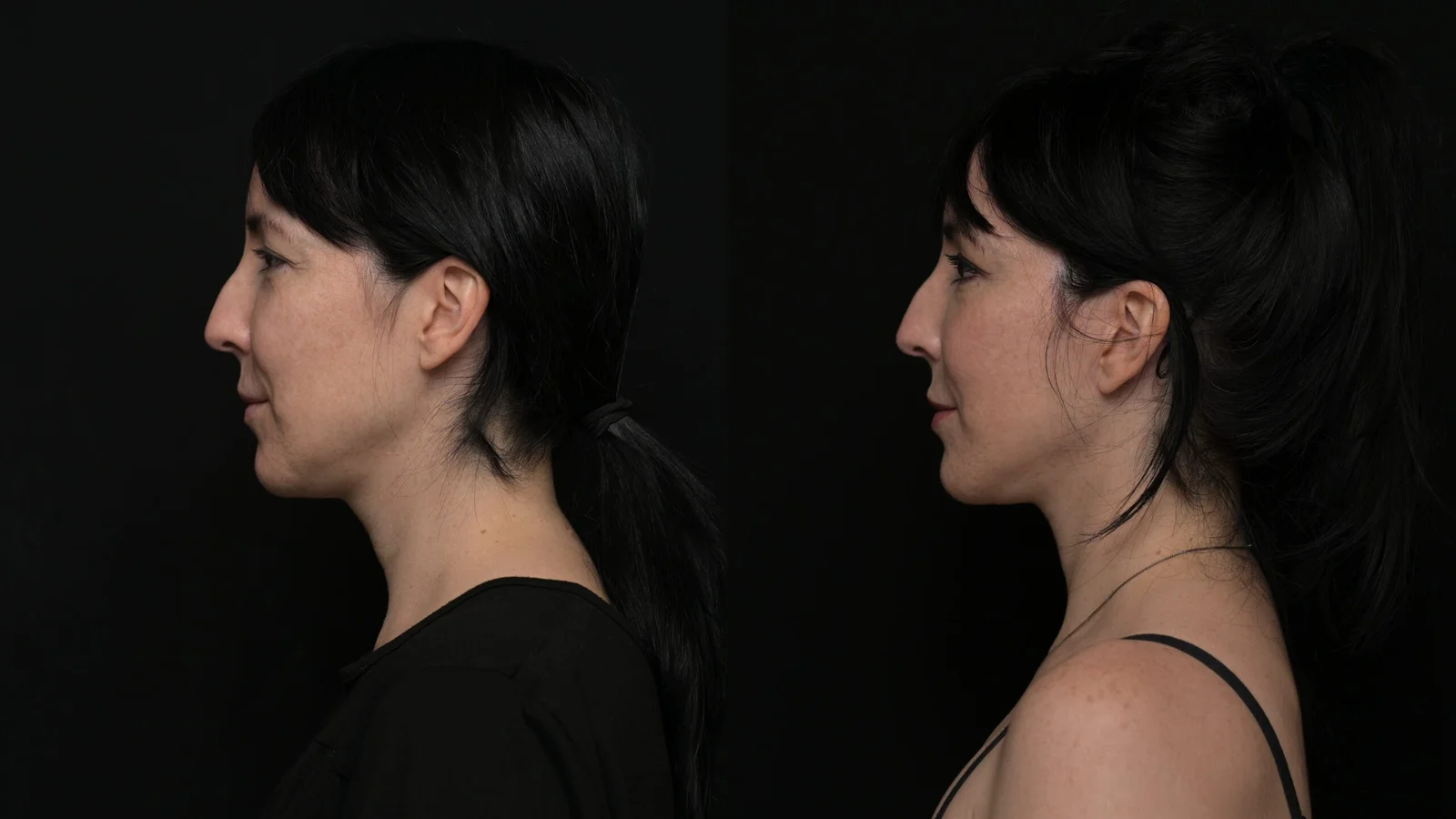 Before-and-after photograph, deep plane facelift and neck lift