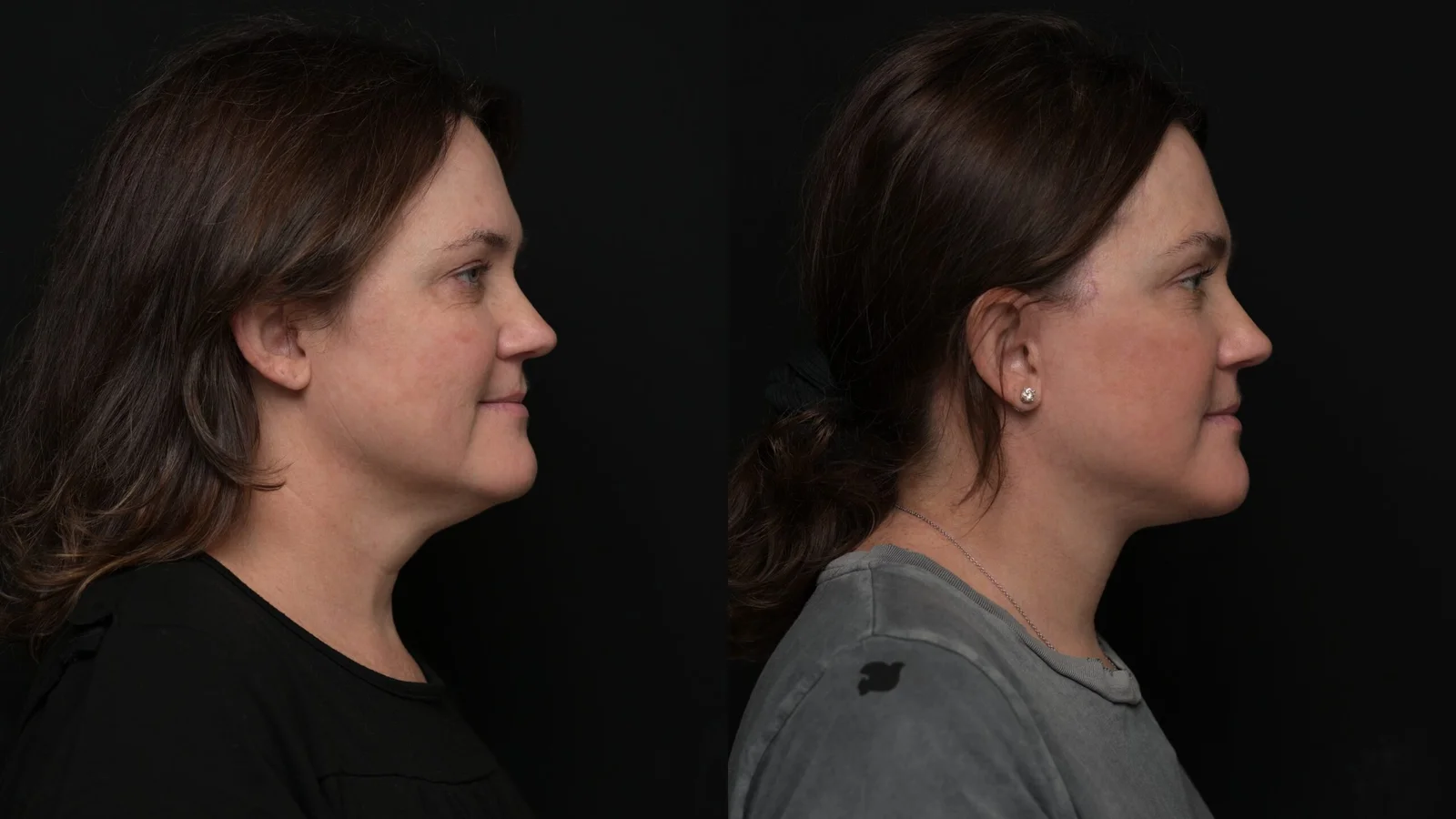 Before-and-after photograph, deep plane facelift and neck lift