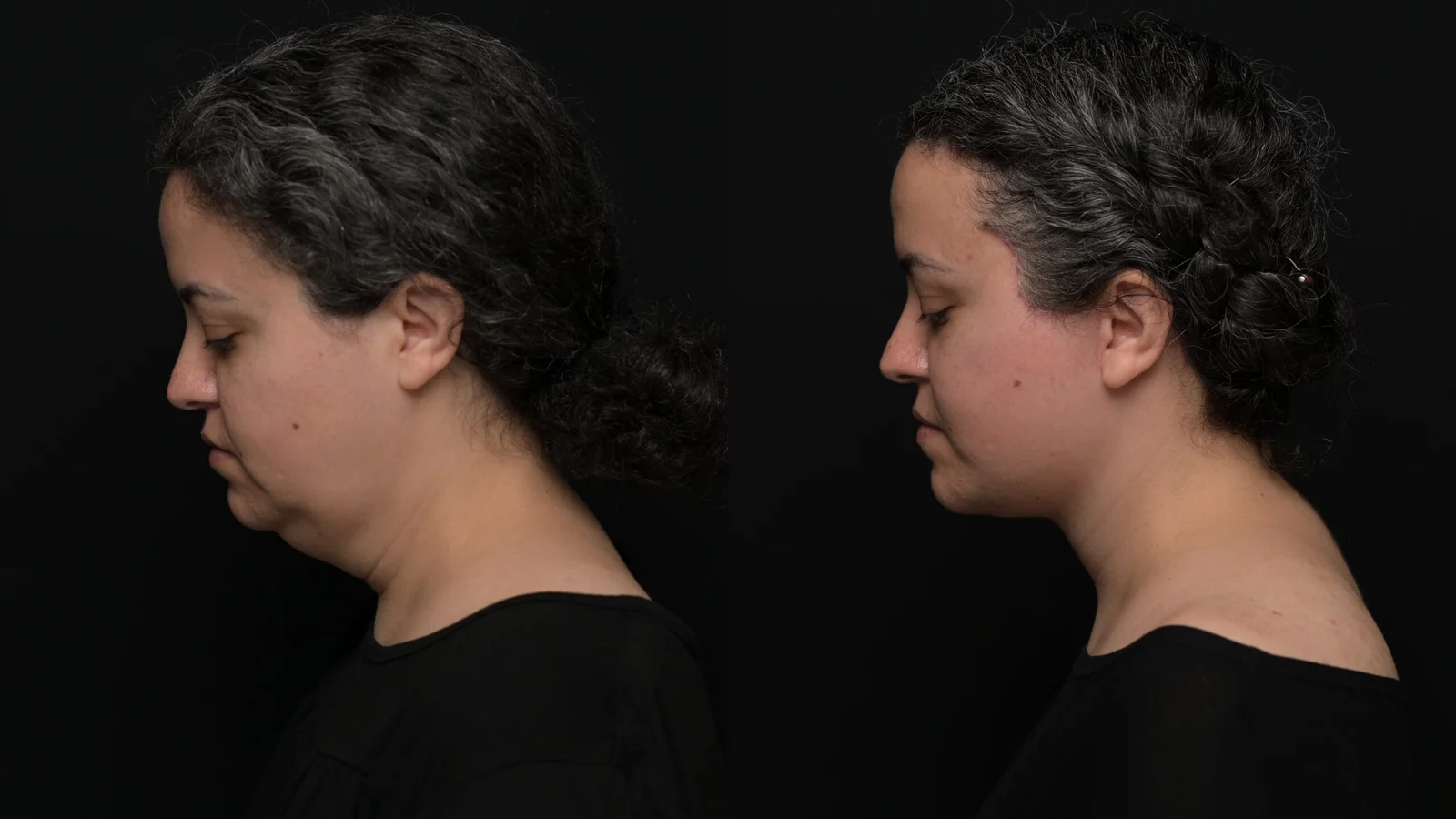 Before-and-after photograph, deep plane facelift and neck lift