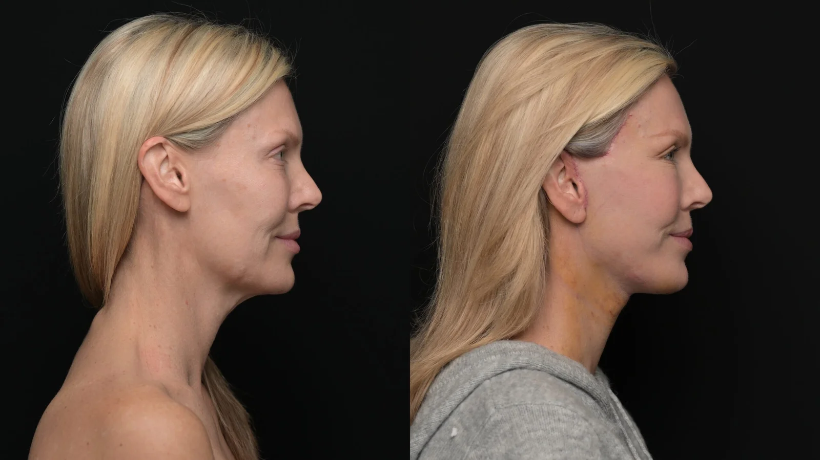Before-and-after photograph, deep plane facelift and neck lift