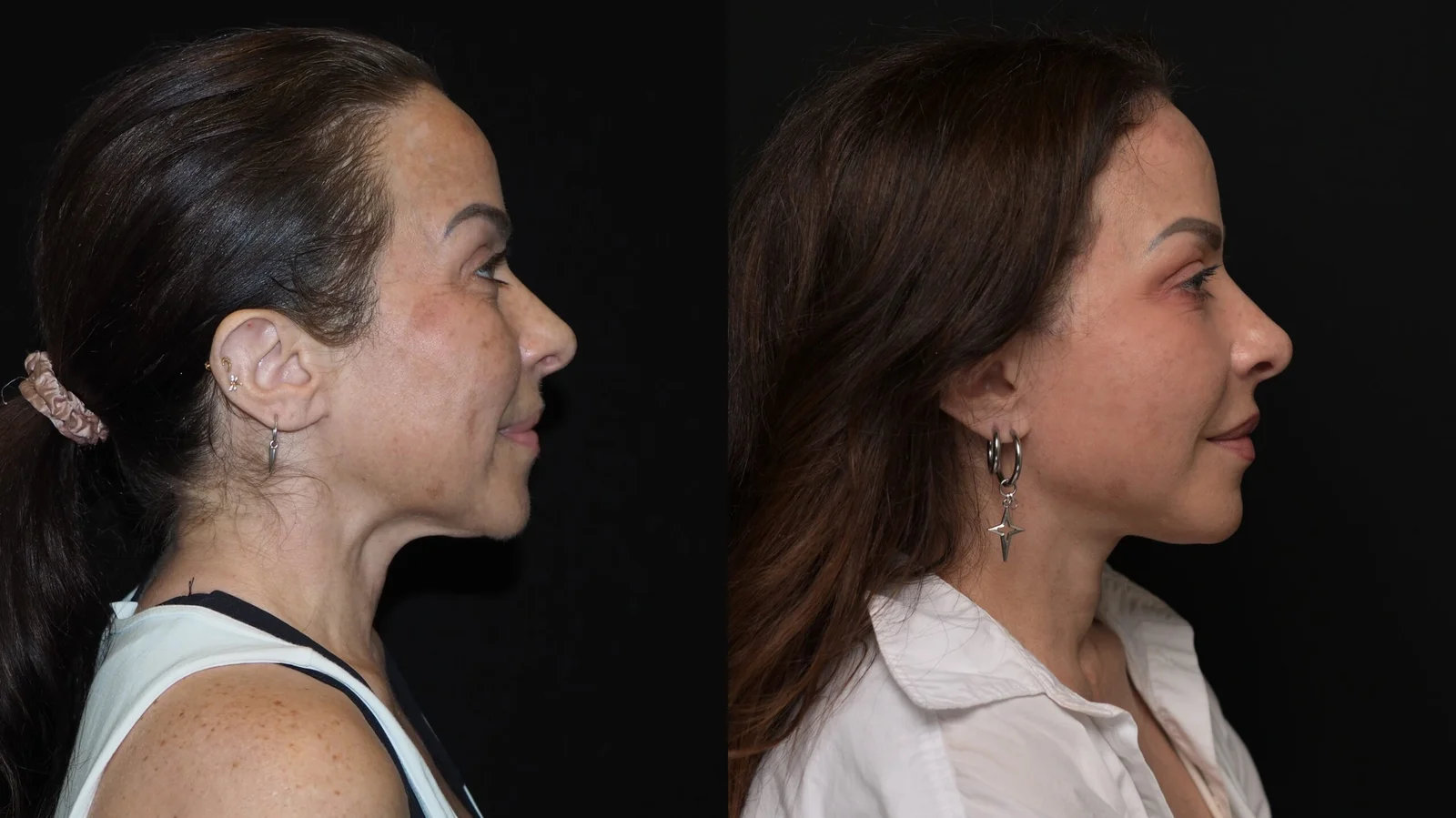Before-and-after photograph, deep plane facelift and neck lift