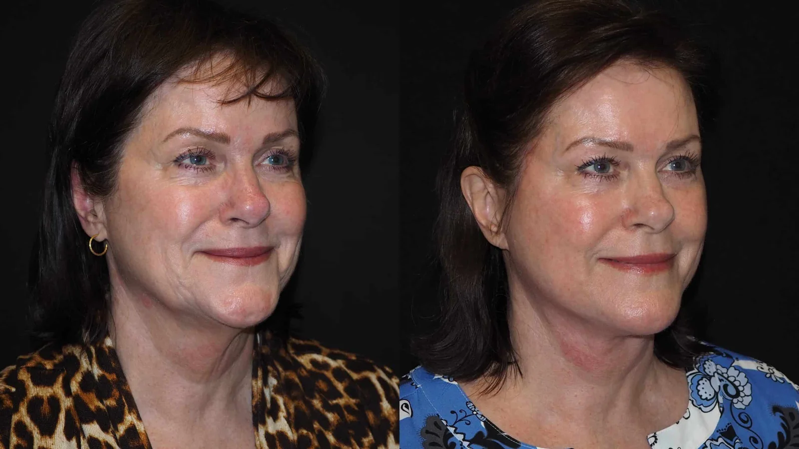Before-and-after photograph, deep plane facelift and neck lift