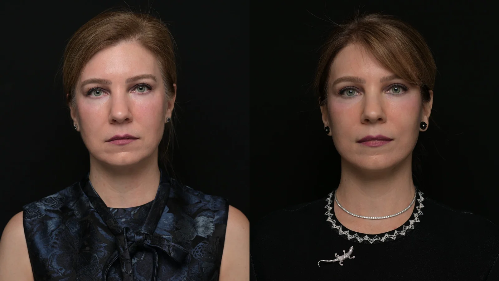 Before-and-after photograph, deep plane facelift and neck lift