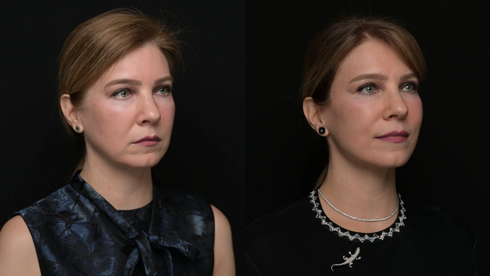 Before-and-after photograph, deep plane facelift and neck lift