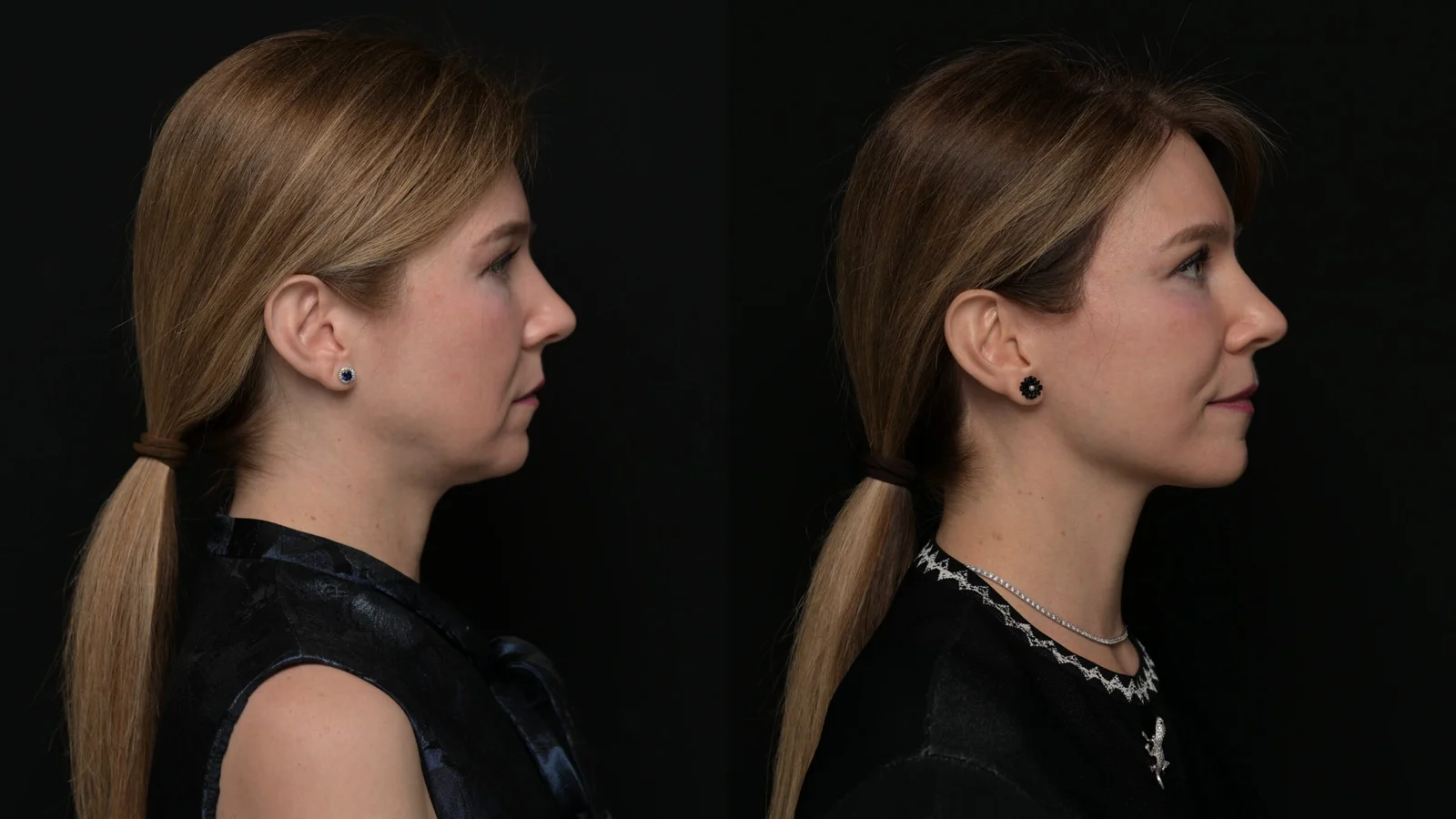 Before-and-after photograph, deep plane facelift and neck lift