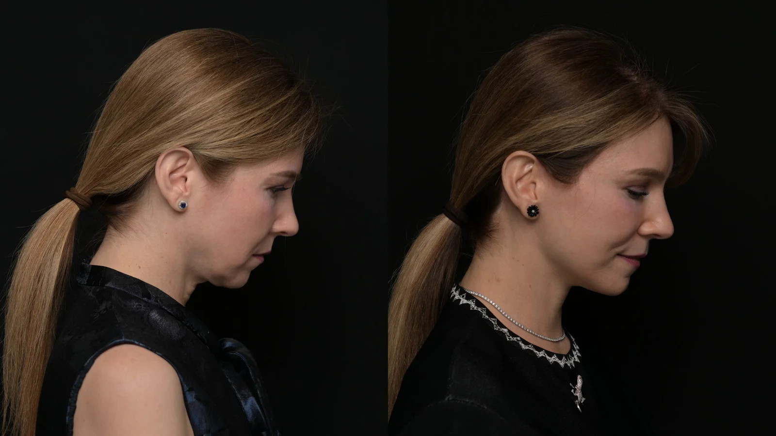 Before-and-after photograph, deep plane facelift and neck lift