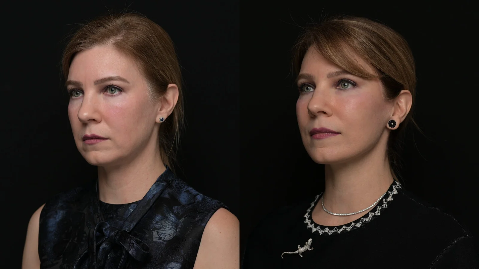 Before-and-after photograph, deep plane facelift and neck lift