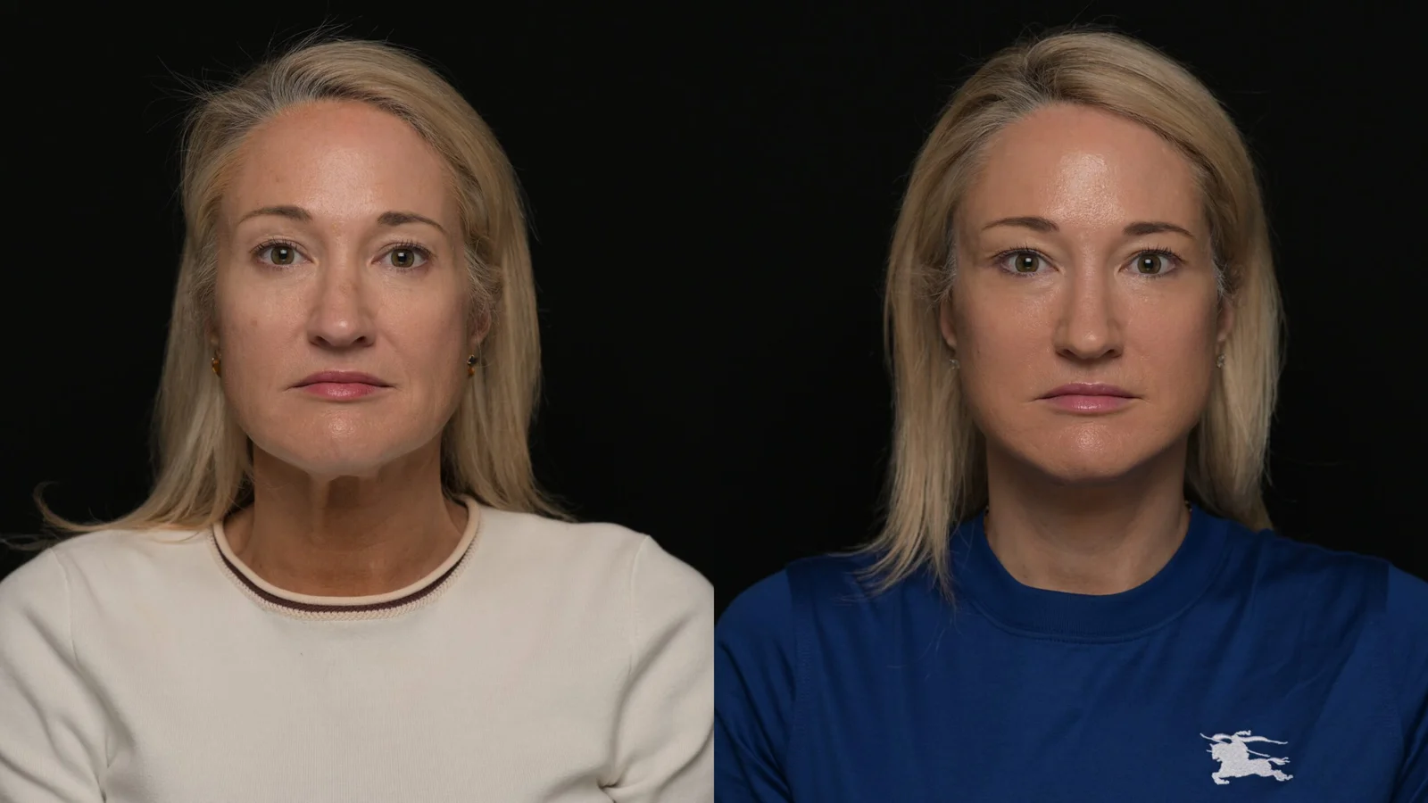 Before-and-after photograph, deep plane facelift and neck lift