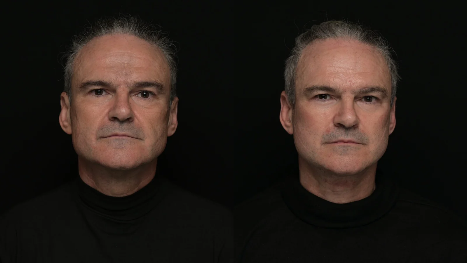 Before-and-after photograph, deep plane facelift and neck lift