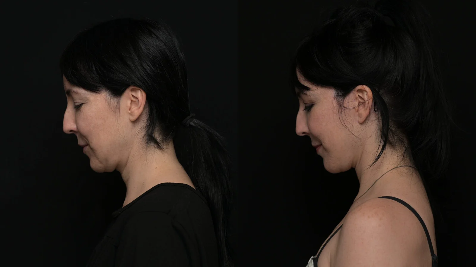 Before-and-after photograph, deep plane facelift and neck lift