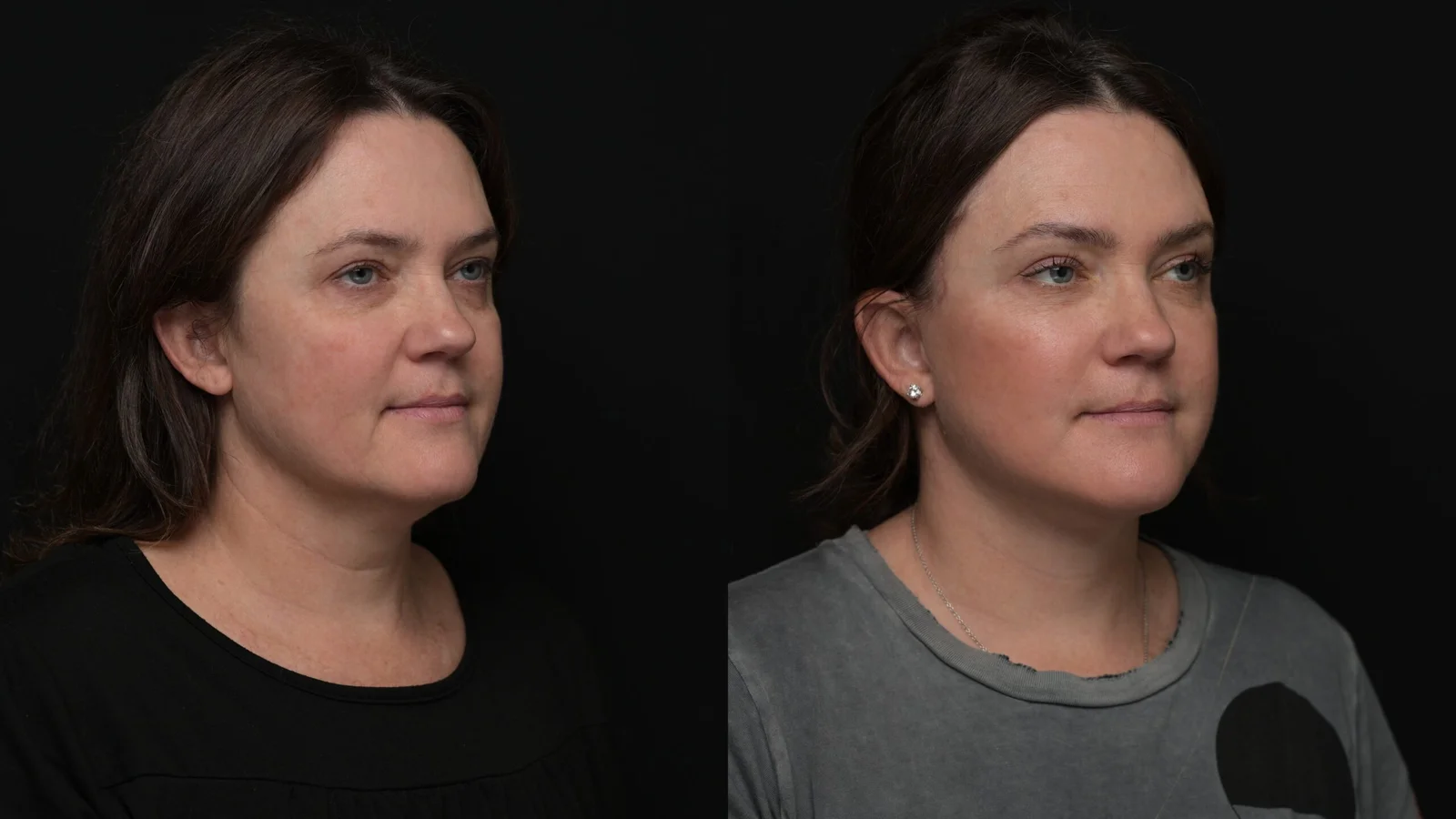 Before-and-after photograph, deep plane facelift and neck lift