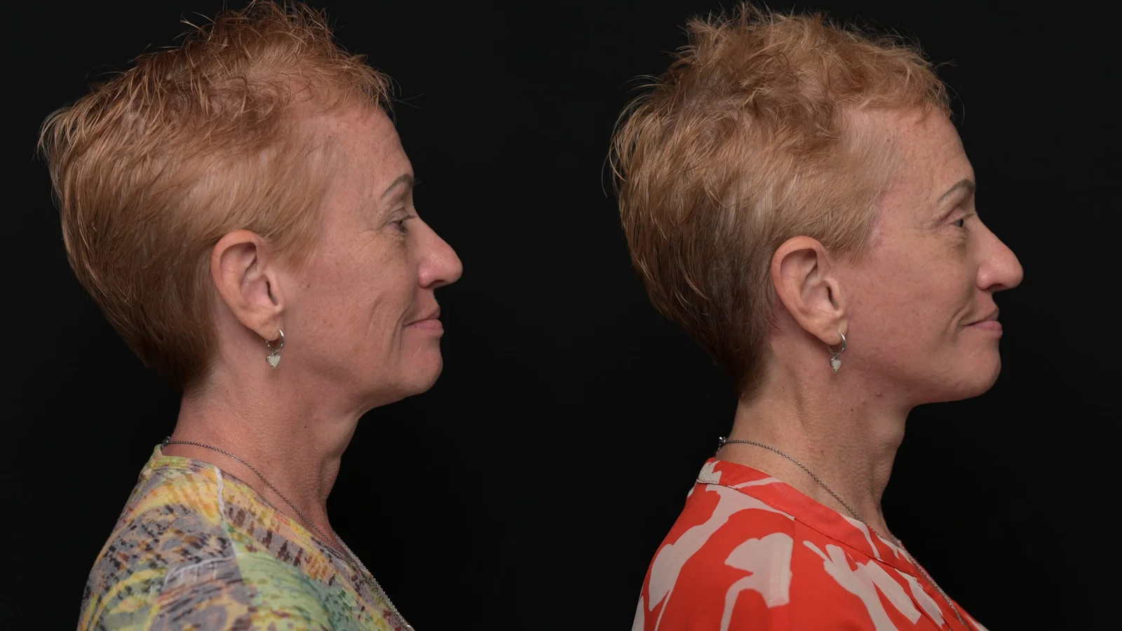 Before-and-after photograph, deep plane facelift and neck lift
