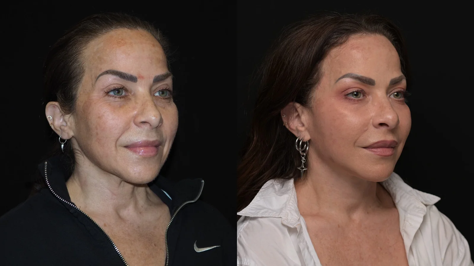 Before-and-after photograph, deep plane facelift and neck lift