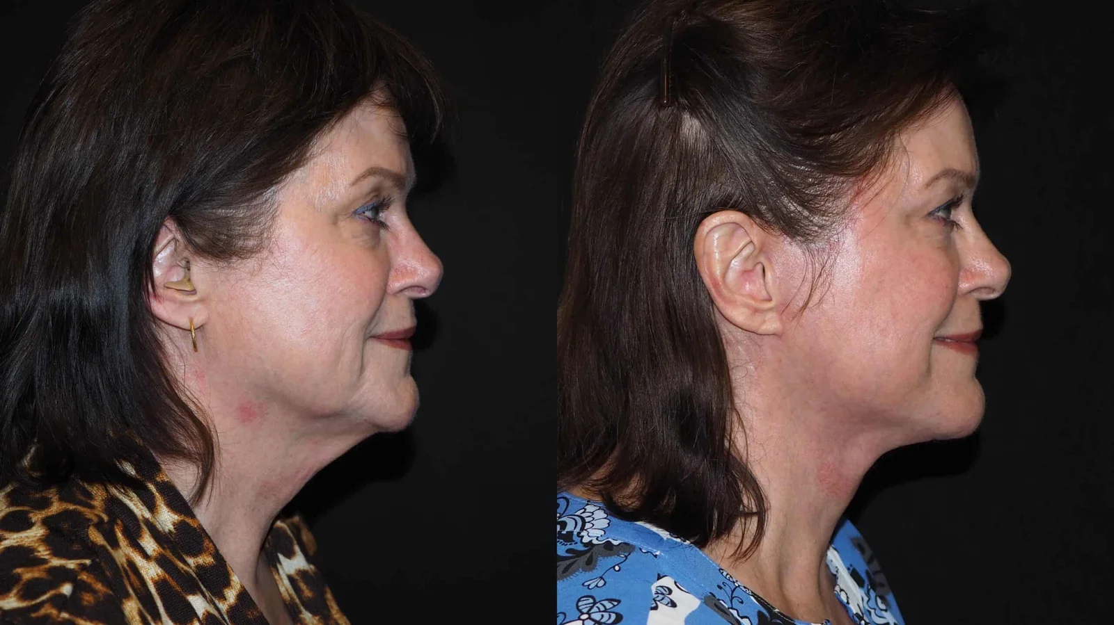 Before-and-after photograph, deep plane facelift and neck lift