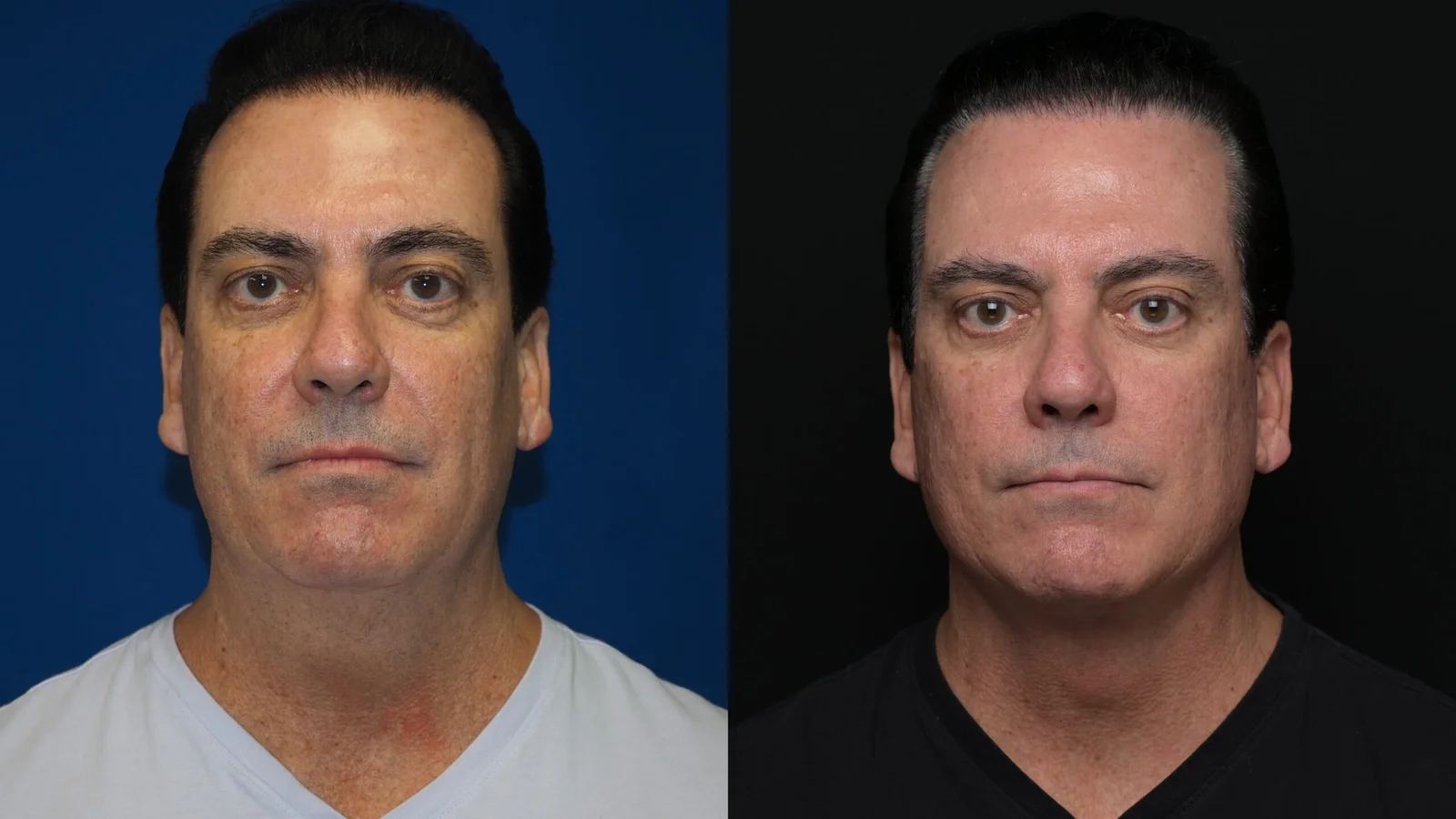 Before-and-after photograph, deep plane facelift and neck lift