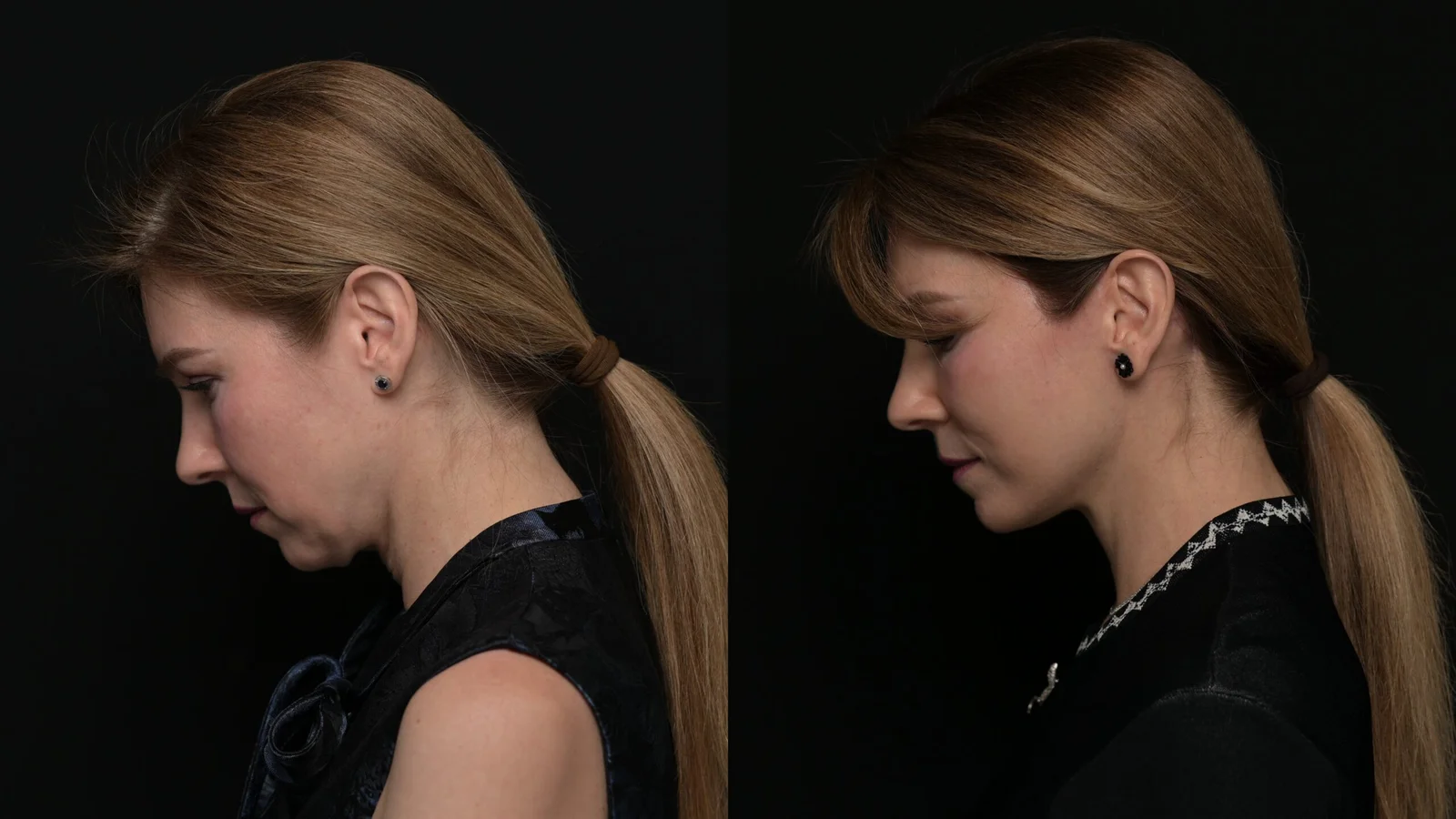 Before-and-after photograph, deep plane facelift and neck lift