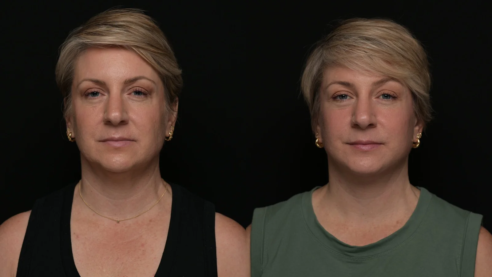 Before-and-after photograph, deep plane facelift and neck lift
