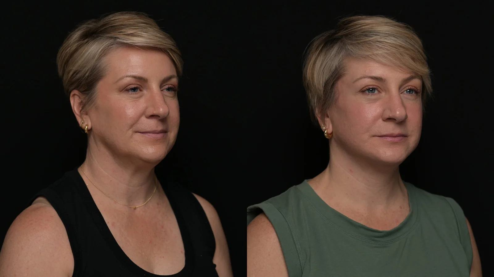 Before-and-after photograph, deep plane facelift and neck lift