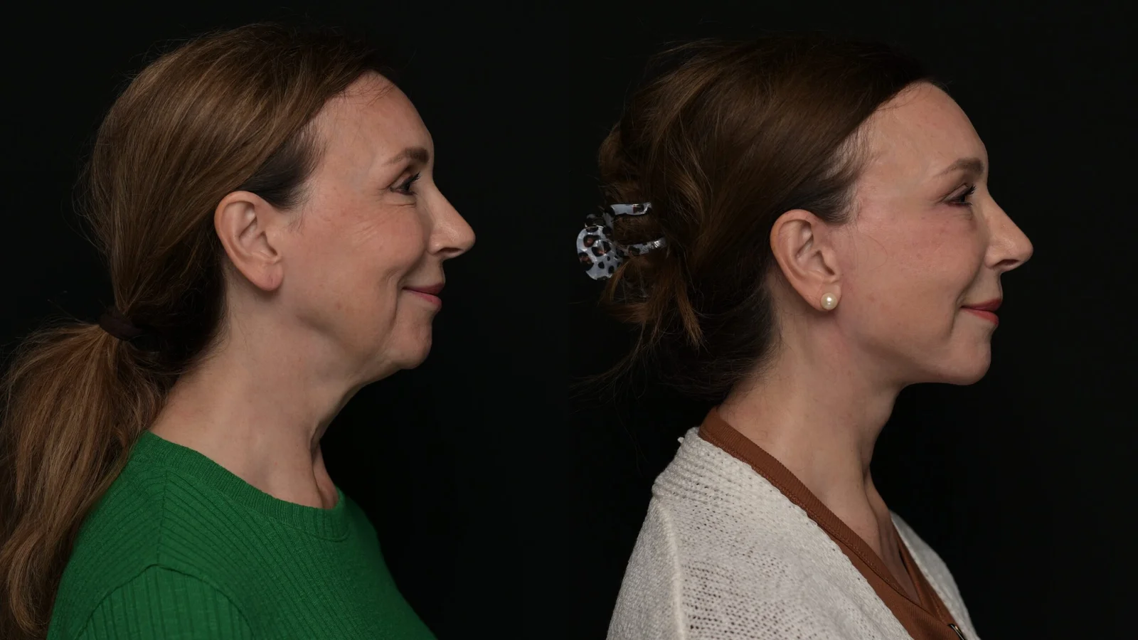 Before-and-after photograph, deep plane facelift and neck lift