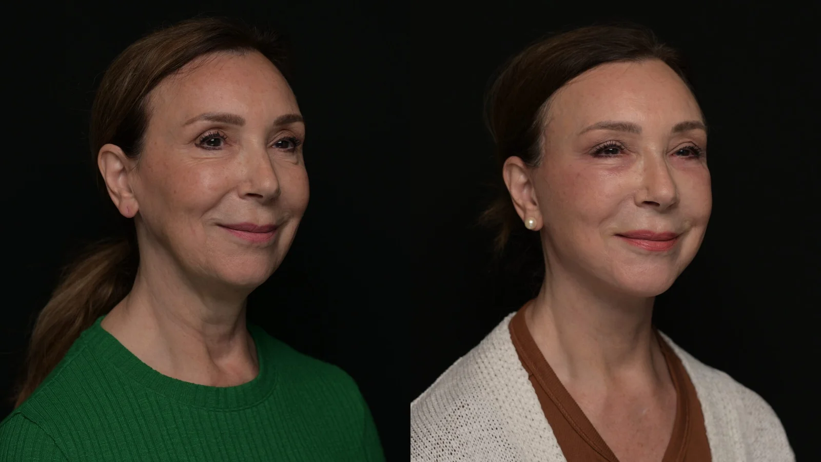 Before-and-after photograph, deep plane facelift and neck lift