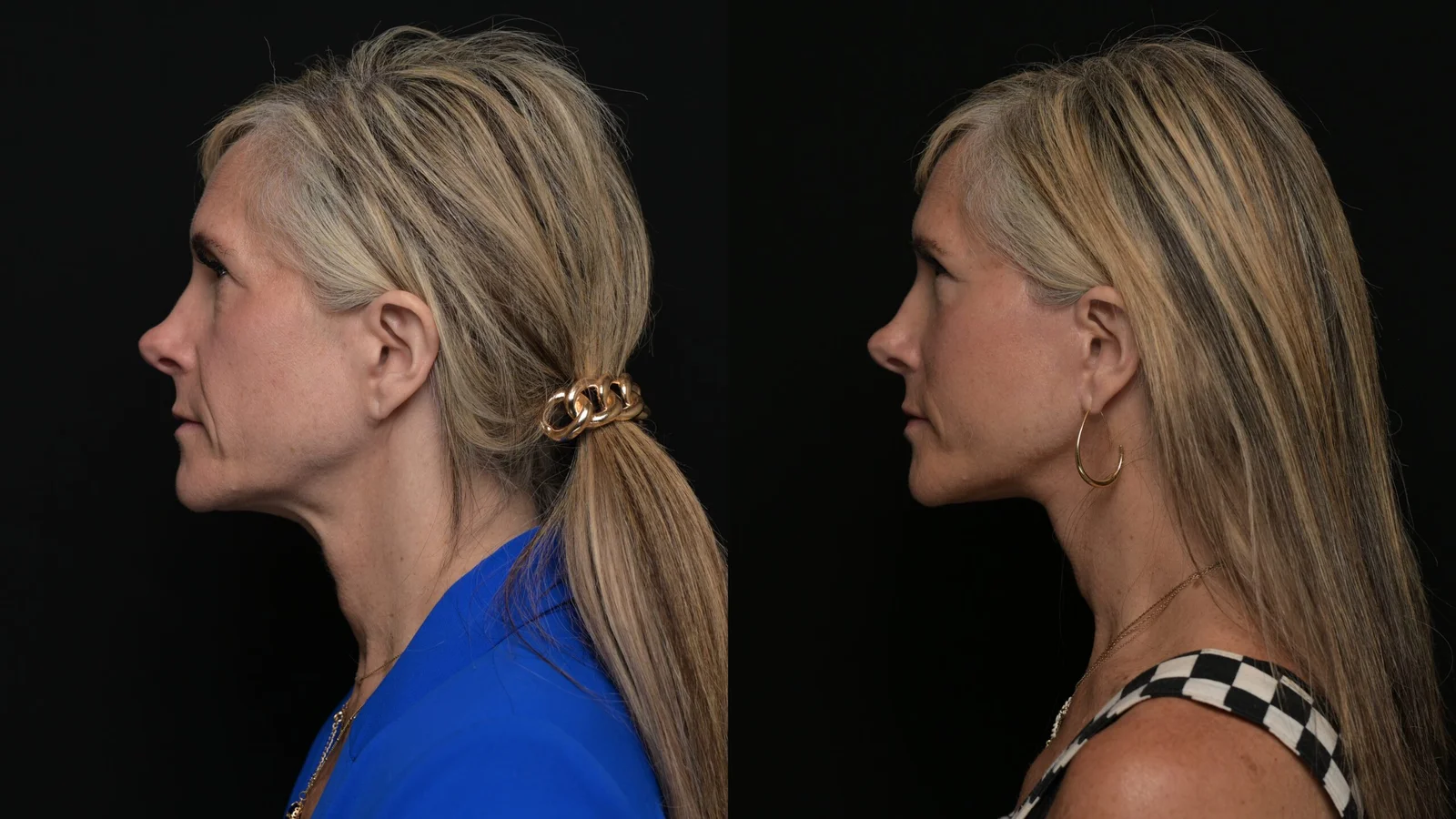 Before-and-after photograph, deep plane facelift and neck lift