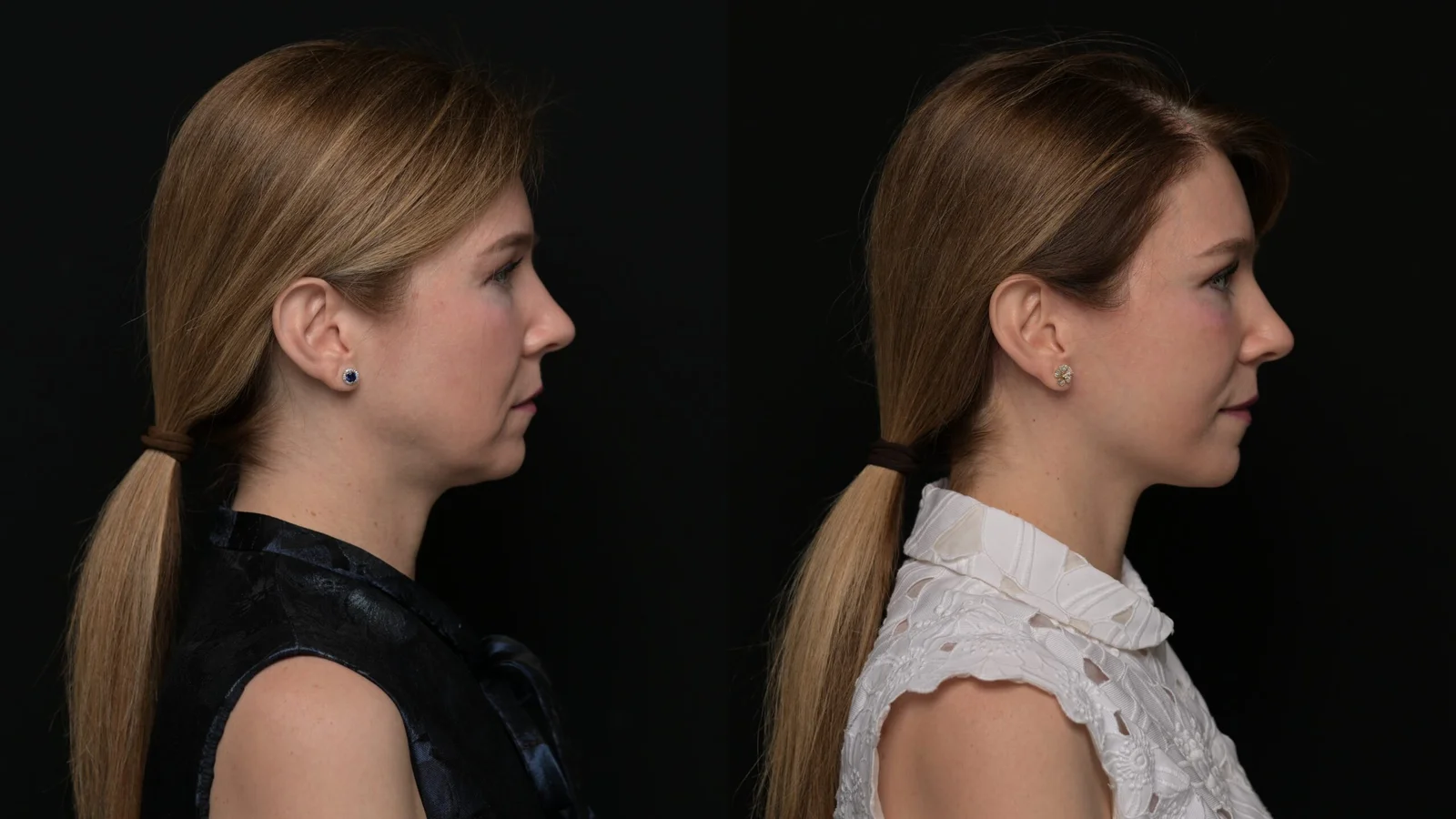 Before-and-after photograph, deep plane facelift and neck lift