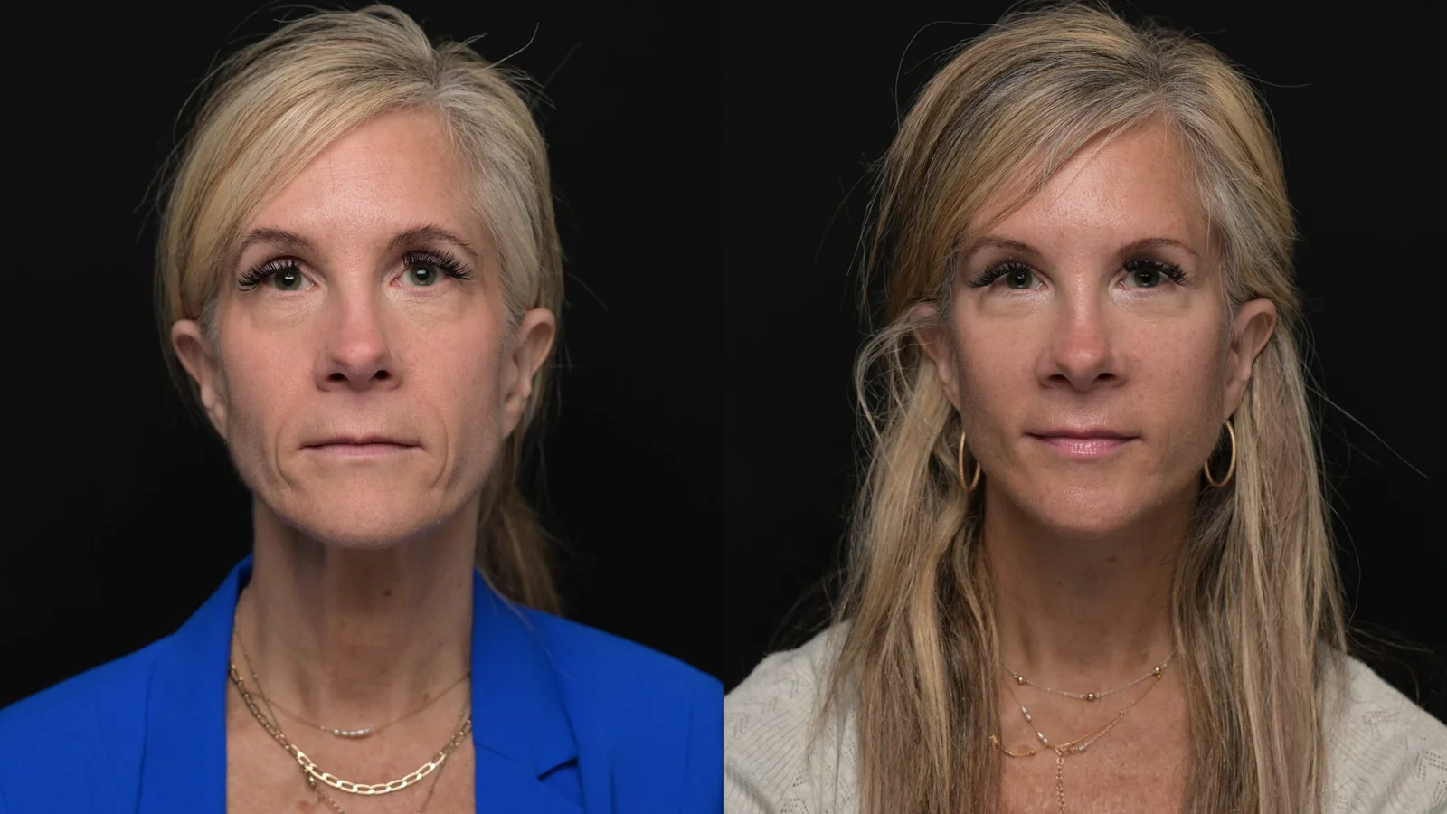 Before-and-after photograph, deep plane facelift and neck lift