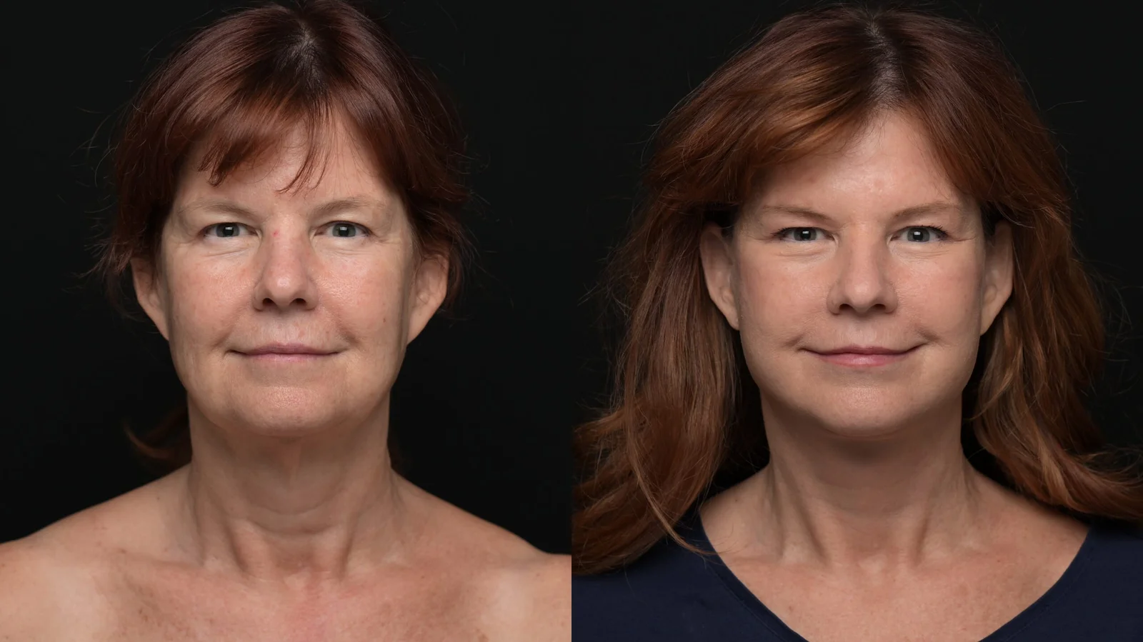 Before-and-after photograph, deep plane facelift and neck lift