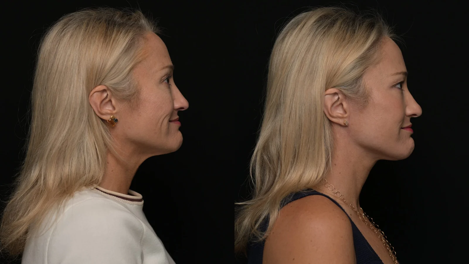 Before-and-after photograph, deep plane facelift and neck lift