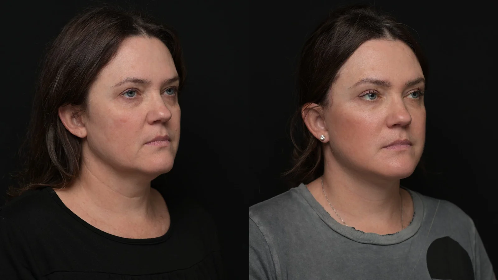 Before-and-after photograph, deep plane facelift and neck lift