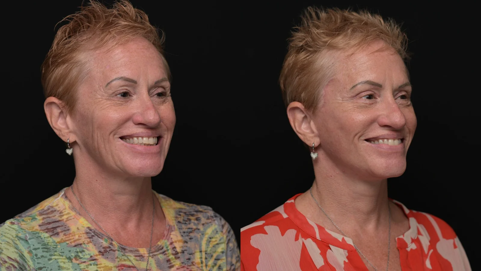Before-and-after photograph, deep plane facelift and neck lift