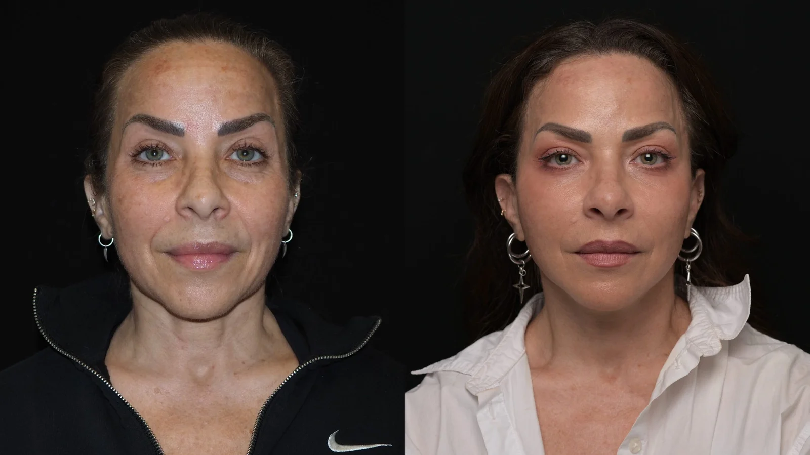 Before-and-after photograph, deep plane facelift and neck lift