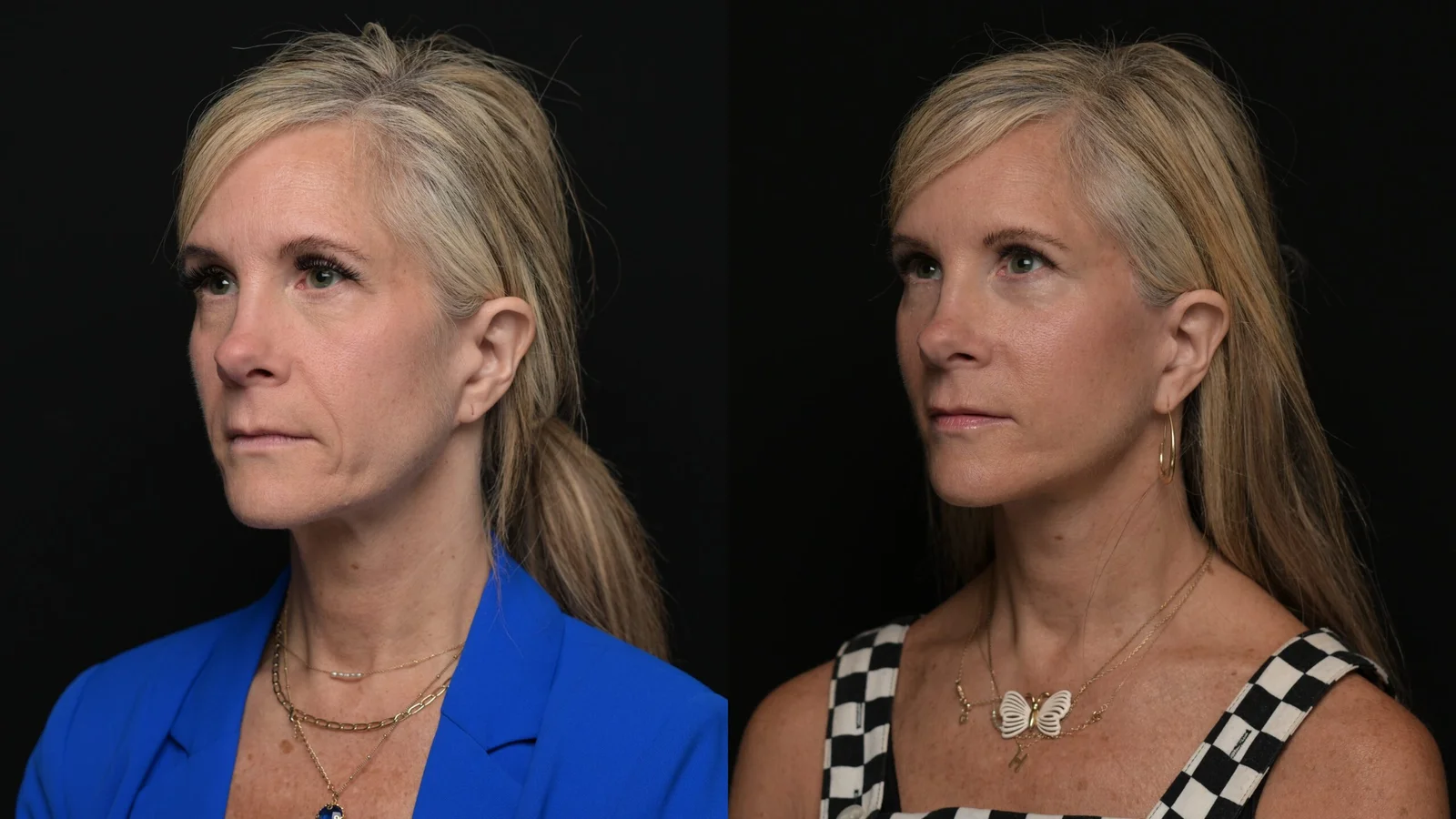 Before-and-after photograph, deep plane facelift and neck lift